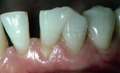 fusión dental