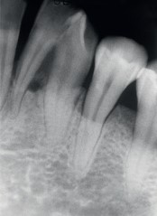 radiografía fusión dental