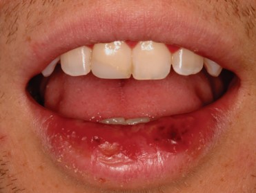 Gingivoestomatitis herpetica aguda labios