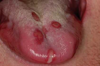 Gingivoestomatitis herpetica aguda lengua