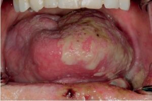 Herpes Zoster lengua ulcerada