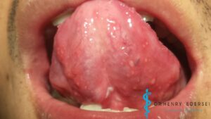 Herpes Zoster fotos lengua