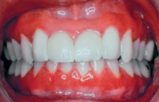 GINGIVITIS DE CÉLULAS PLASMÁTICAS