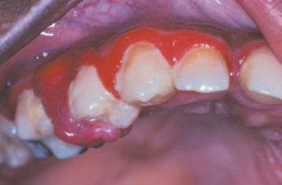 Gingivitis crónica hiperplásica con granuloma piógeno