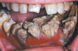 Gingivitis crónica