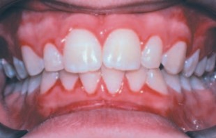 Gingivitis marginal