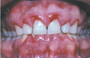 Gingivitis relacionada con la respiración bucal