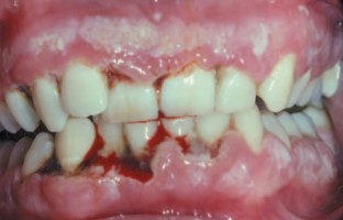 Gingivitis ulcerativa necrotizante (GUN)