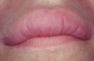 Granulomatosis orofacial (queilitis granulomatosa)