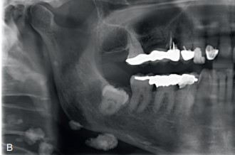 Radiografía panorámica que muestra ganglios linfáticos calcificados en el cuello derecho